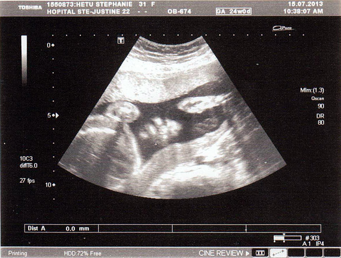 Journal d'une maman FLP Échographies