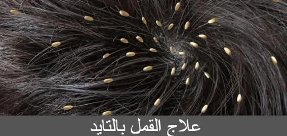 علاج القمل بالتايد