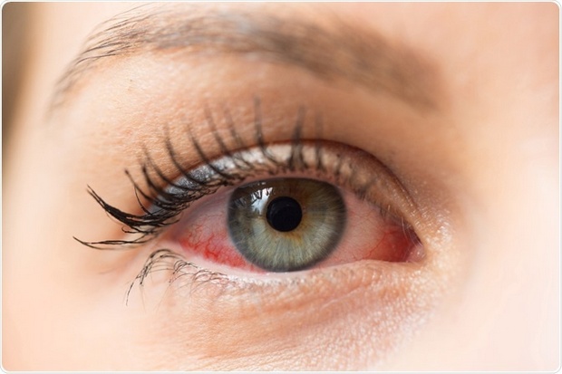 É COVID-19 ou alergia ocular? Oftalmologista explica