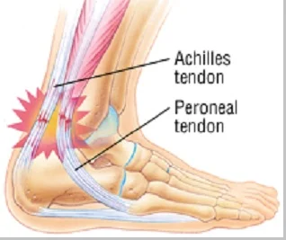 Tendonitis (peradangan tendon) - berbagaireviews.com