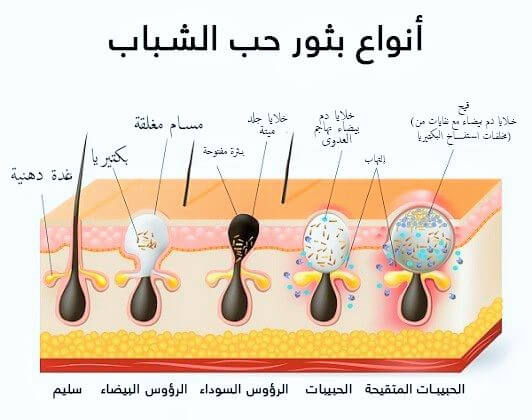 أنواع حب الشباب أنواع حب الشباب