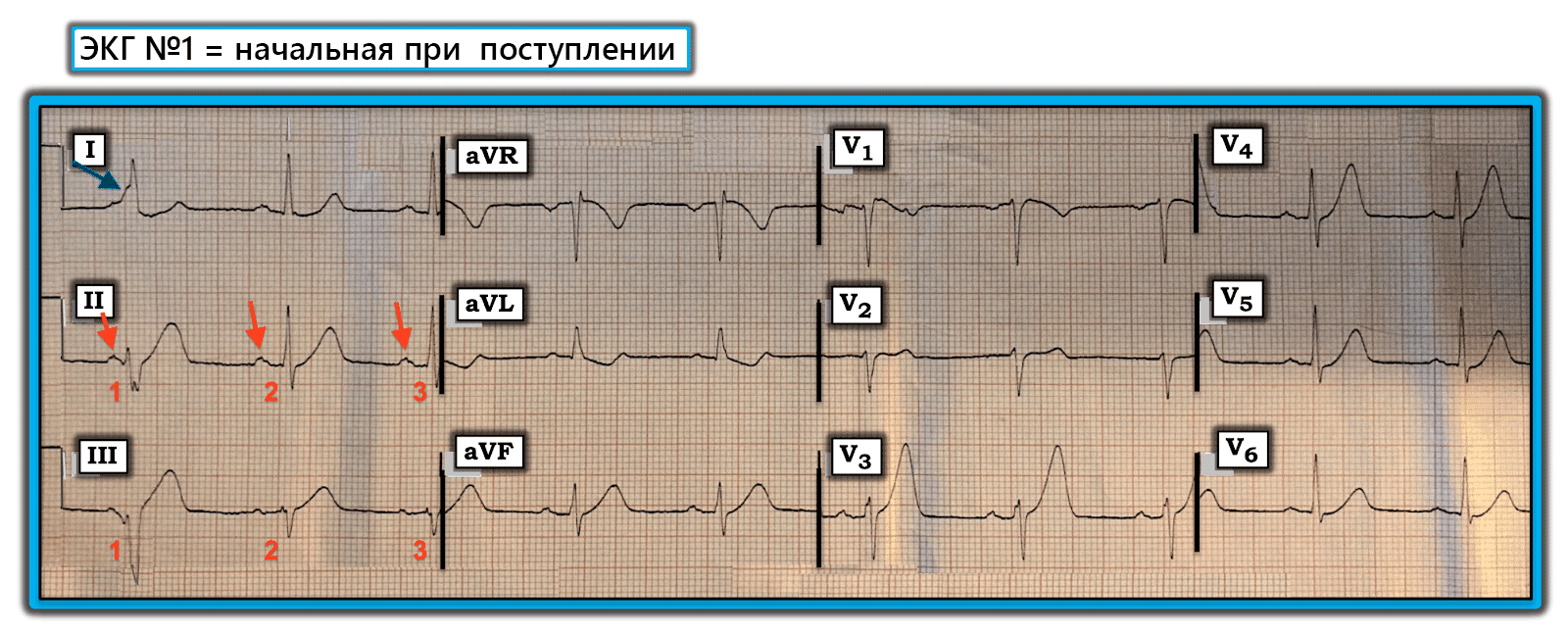 врач кардиограмма прошлого читать. экг расшифровка у взрослых норма в таблице. электрическая систола желудочков показатели экг. экг зубец р в норме и при патологии. терапевт экг при беременности.