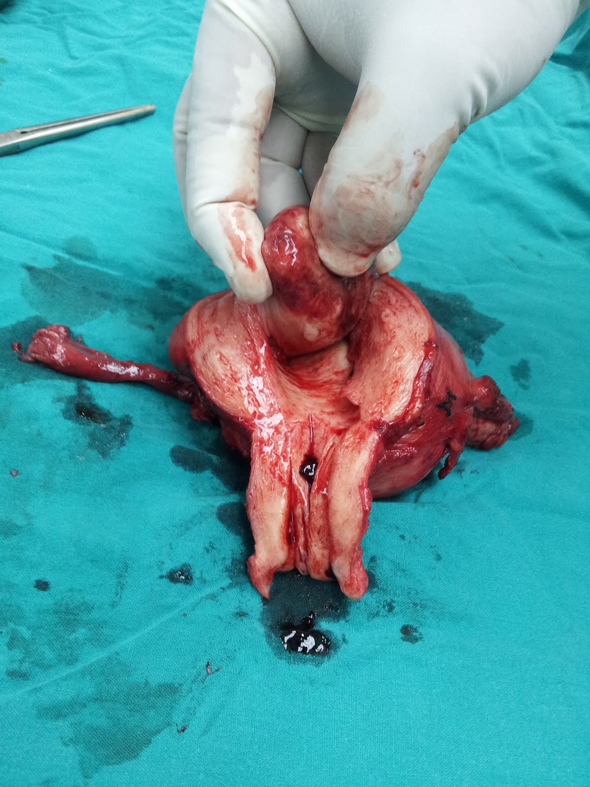 Hysterectomy for submucus fibroid. Done by Dr. Alaa Mosbah