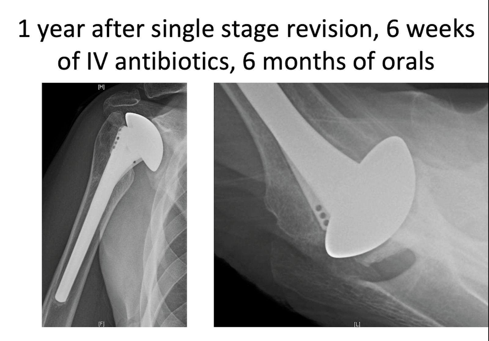 Shoulder Arthritis/Joint Replacement Rotator cuff tears Single stage