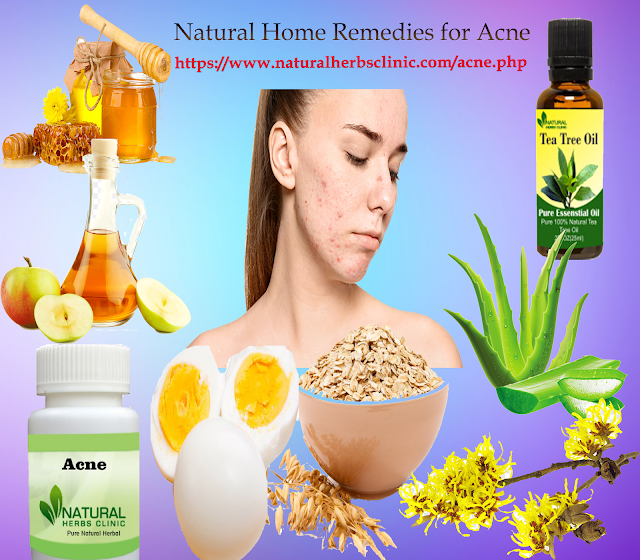 Get Rid Of Acne with Natural Home Remedies