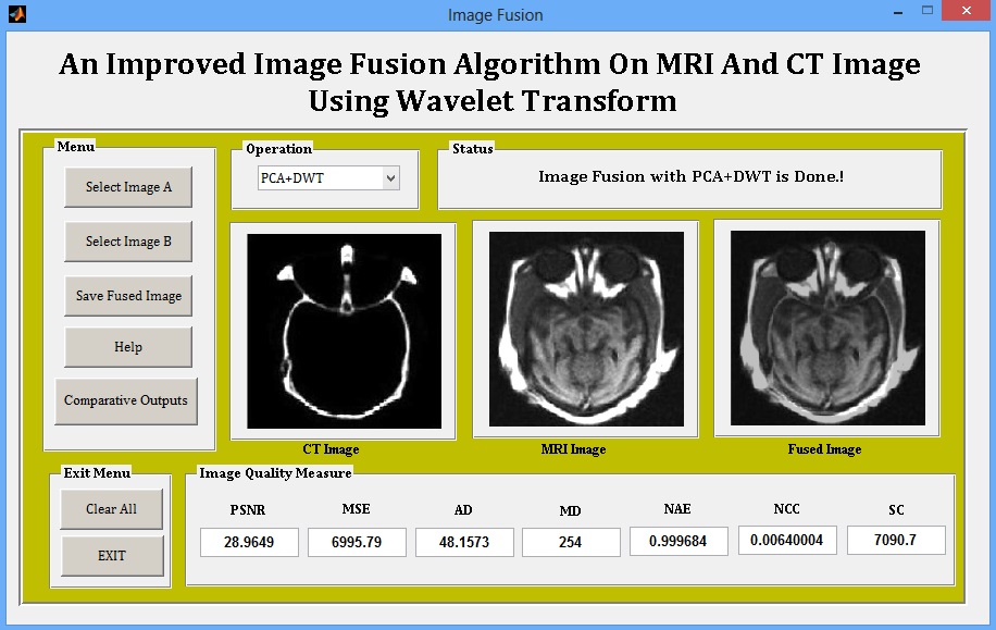 Image Fusion Algorithm On MRI And CT Image Using Wavelet Transform