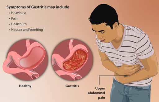 Gastritis, Dari Definisi Sampai Pencegahan