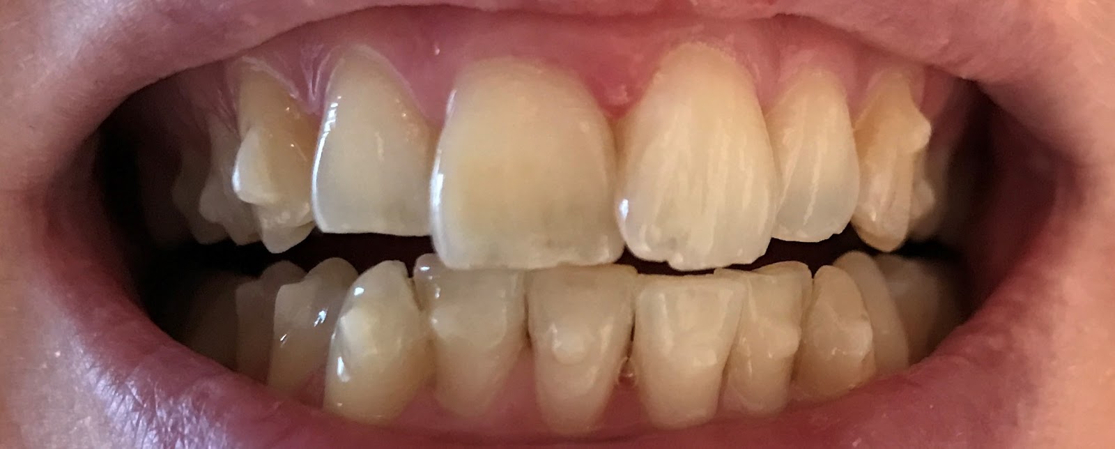 Erfahrungen Mit Invisalign 2017