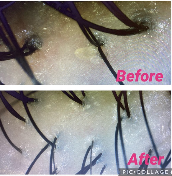 Shuqing's Story Scalp Treatment Review Japan Hair Growth Consultants