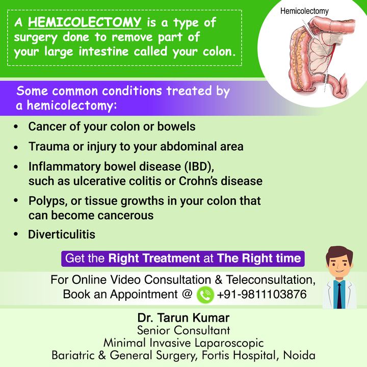 Dr Tarun Kumar Surgeon Some Common Conditions Treated By Hemicolectomy