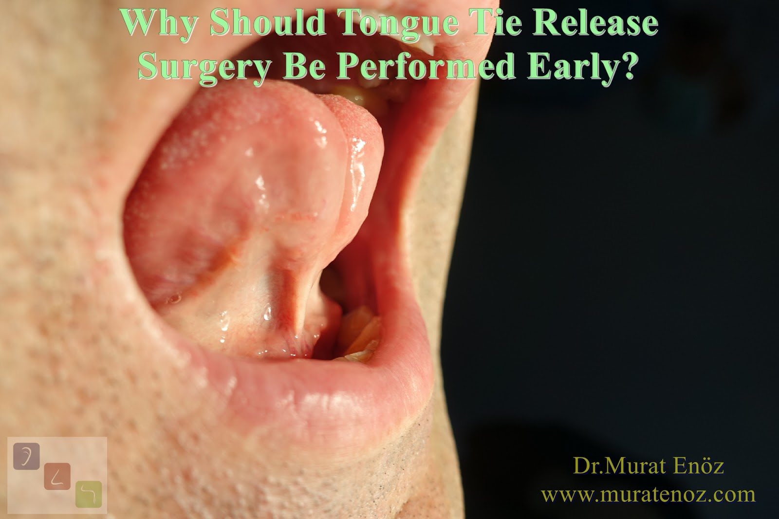 Health Zone Turkey Why Should Tongue Tie Release Surgery Be Performed Early