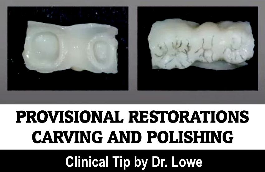 PROVISIONAL RESTORATIONS Carving and polishing Clinical Tip by Dr. Lowe