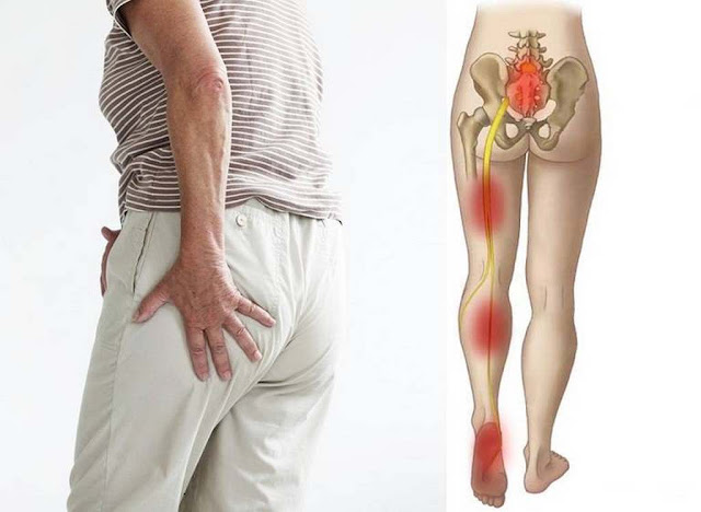 What is sciatica 7 exercises to treat sciatica at home