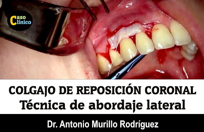 CIRUGÍA PERIODONTAL: Colgajo de reposición coronal múltiple mediante técnica de abordaje lateral - Dr. Antonio Murillo Rodríguez