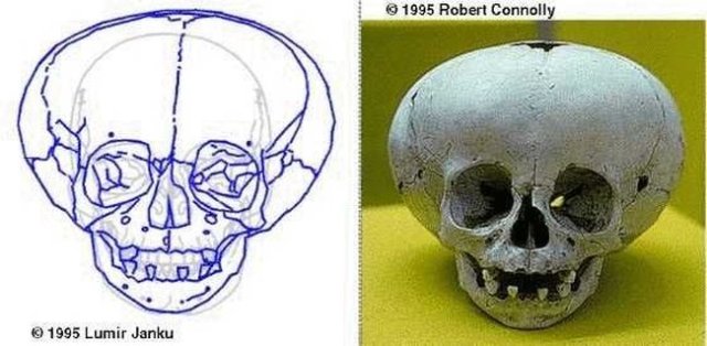 Искусственная деформация черепа человека