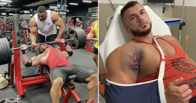 Bodybuilder's Pec Muscle Torn From Bone During 220kg Bench Press