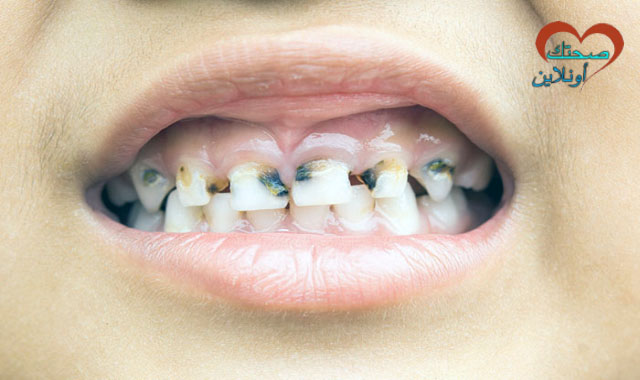 تسوس الأسنان عند الأطفال أسبابه وطرق العلاج