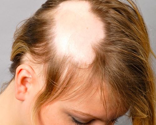 Alopecia Areata Hair Loss Causes Symptoms Treatment