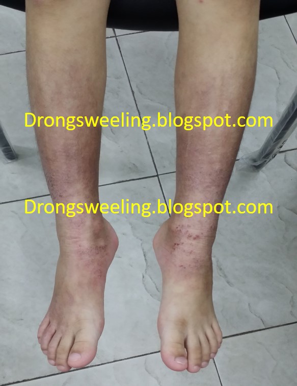 TCM News TCM Eczema Treatment TCM Physician Treatment for Eczema