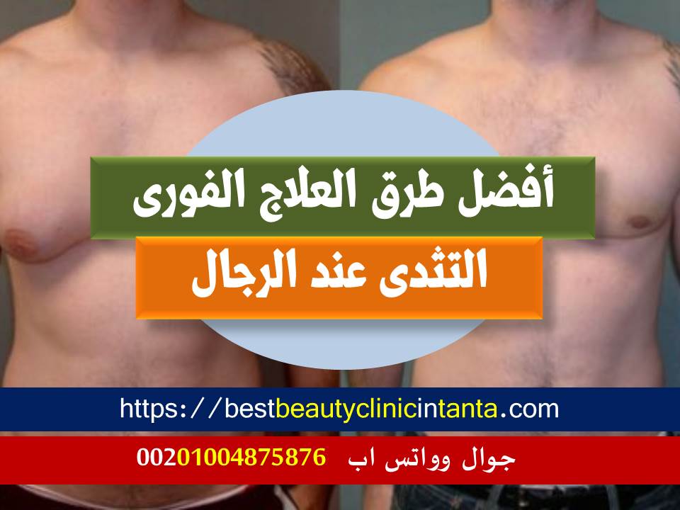 افضل مركز لعلاج التثدى عند الرجال فى طنطا ووسط الدلتا علاج فورى للتثدى عند الرجال فى طنطا ووسط الدلتا