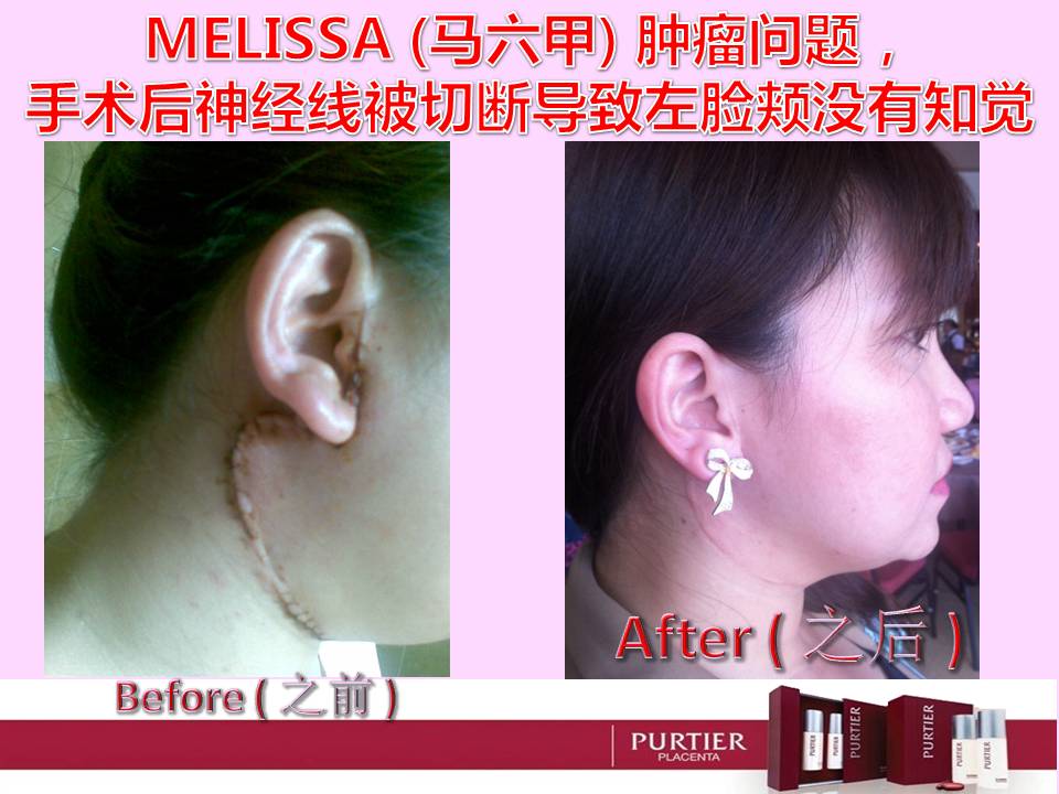 MELLISA (MALACCA)-LYMPH NODES OPERATED AREA-SCARE RECOVER-LESS VISIBLE-LOST SENSATION (RIGHT FACE)