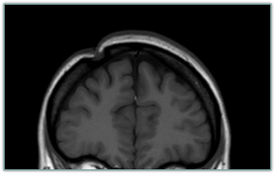 MRI after Brain Surgery - missing skullbone