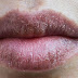 Σκασμένα χείλη τον χειμώνα: 9 συμβουλές για να τα θεραπεύσετε