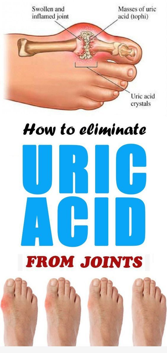 How to eliminate uric acid from joints Healthy Lifestyle
