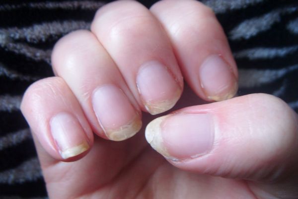 Image result for brittle nails