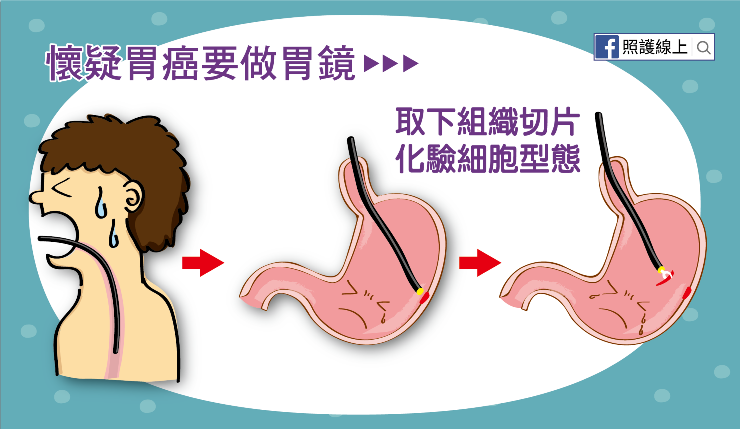 可能沒有症狀、與飲食相關的胃癌(懶人包)-照護線上 懷疑胃癌要做胃鏡