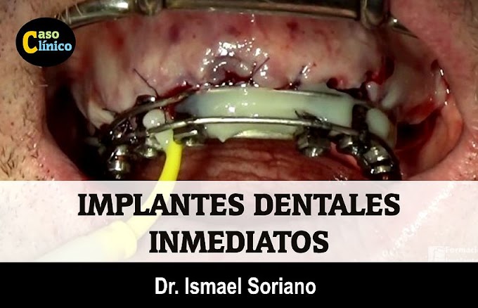 IMPLANTES DENTALES INMEDIATO - Caso Clínico - Dr. Ismael Soriano