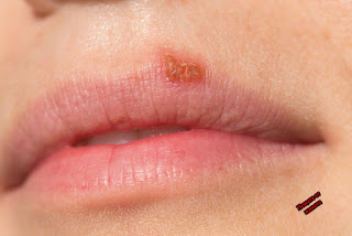 Херпес на устните: причините за поява  и симптоми   