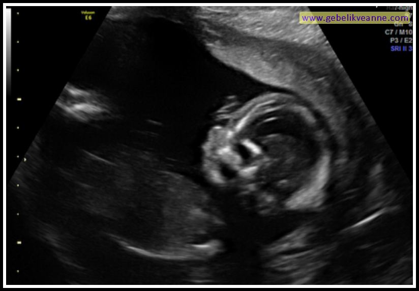 17 Haftalık Gebelik (Hamilelik) Ultrason Görüntüleri