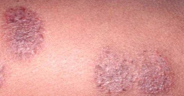 19+ Macam Macam Penyakit Kulit Beserta Gambarnya, Penting!