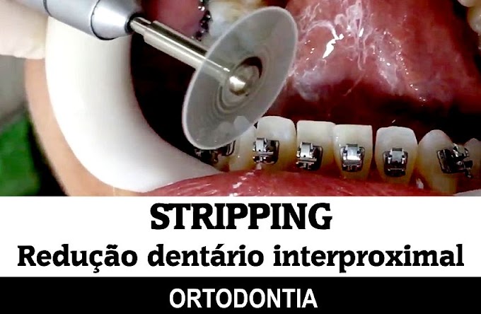 STRIPPING: Desgaste Interproximal em Ortodontia