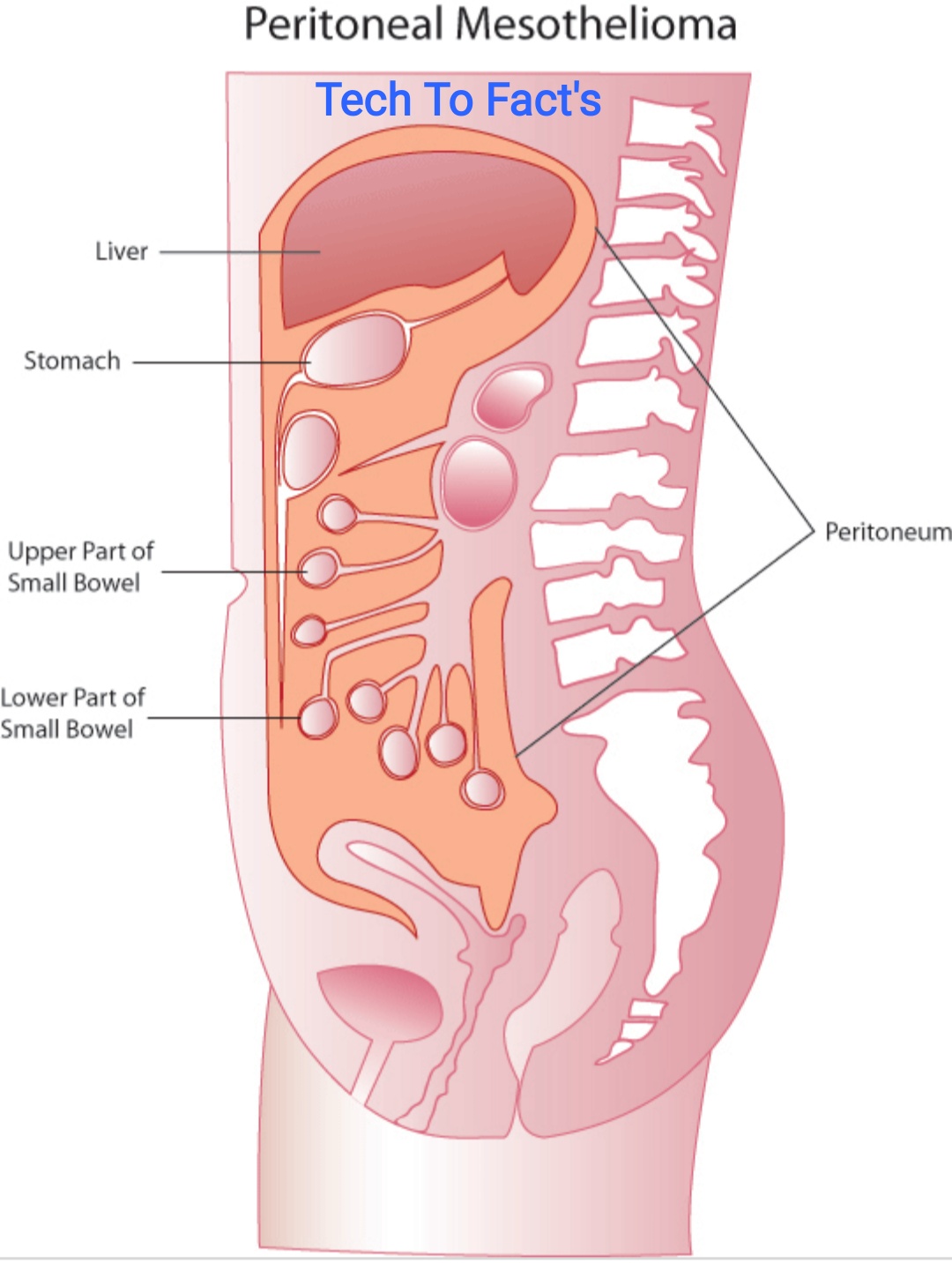 what-is-peritoneal-mesothelioma
