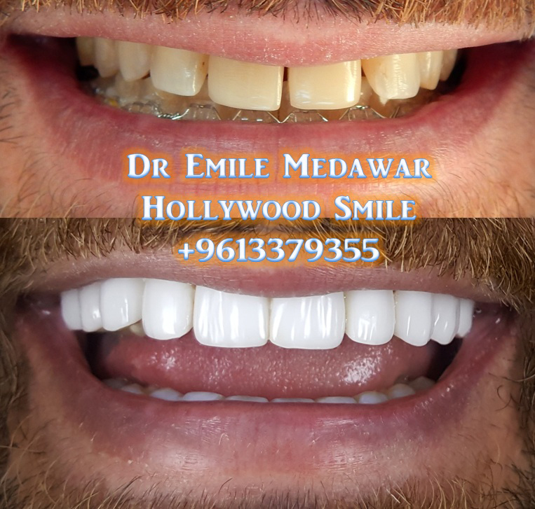 Hollywood Smile Lebanon, Dr Emile Medawar, 00 961 3 379355 veneers dubai