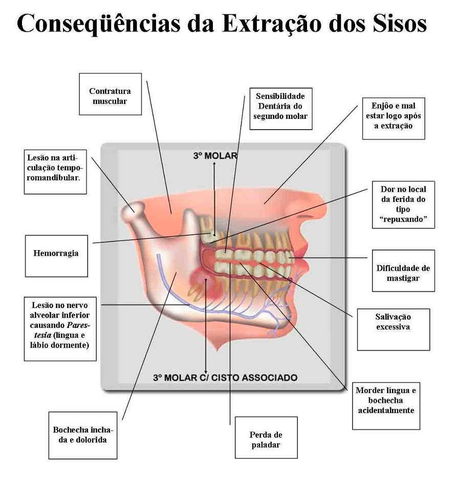 Ortodontia é Arte: Sobre os sisos