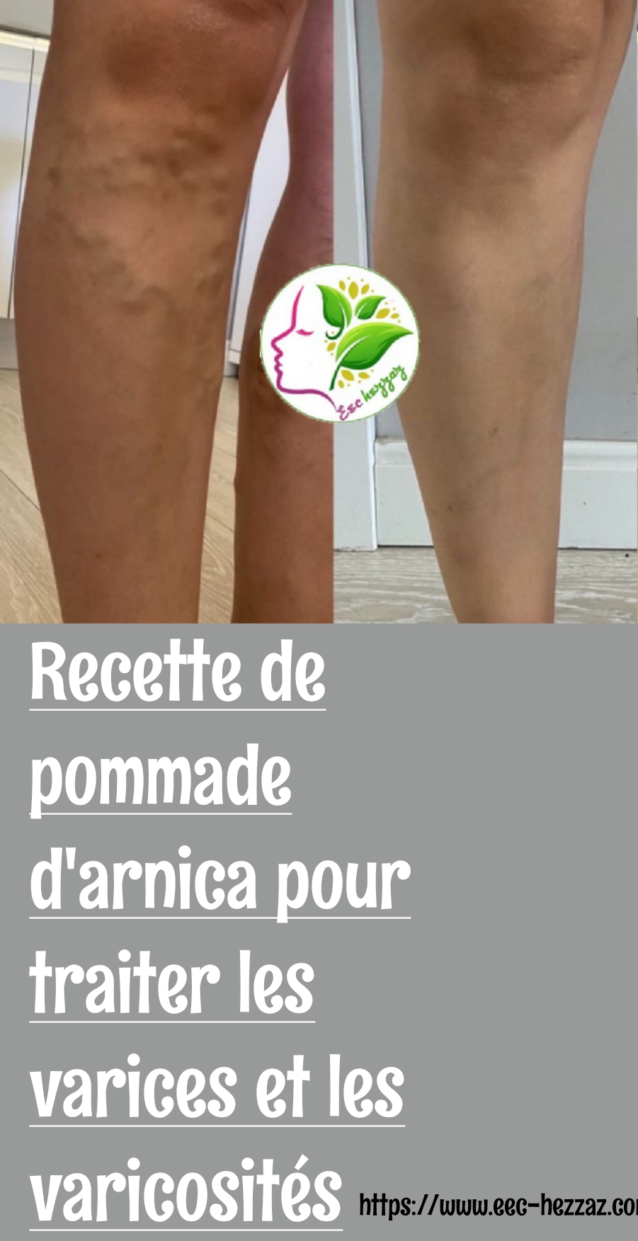 Recette de pommade d'arnica pour traiter les varices et les varicosités