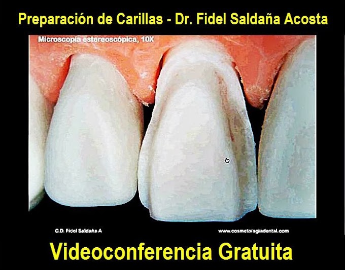 CARILLAS DENTALES: Características de la Preparación - Videoconferencia del Dr. Fidel Saldaña Acosta