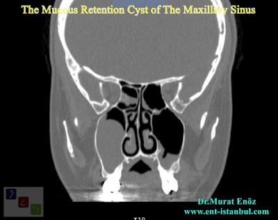 The Mucous Retention Cyst of The Maxillary Sinus