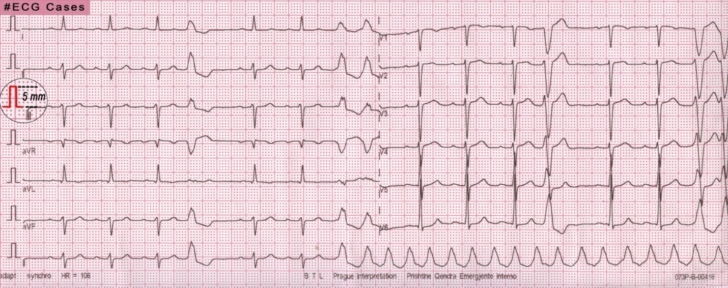 52 years old male with palpitations and dyspnea.