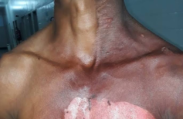 Mulher joga água fervendo no marido enquanto era agredida no Bairro Aeroclube 2 Mulher joga água fervendo no marido enquanto era agredida no Bairro Aeroclube