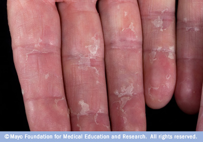 Causes of Peeling Skin on Fingers - Yogawiz