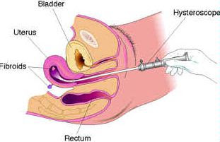 cara mengobati penebalan dinding rahim tanpa perlu operasi