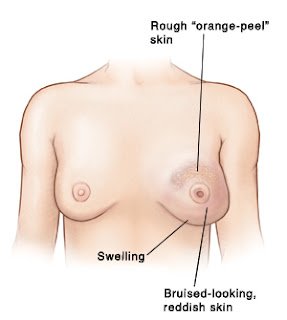 ಸ್ತನ ಕ್ಯಾನ್ಸರನಿಂದ ಹುಷಾರಾಗಿರಿ : Breast Cancer in Kannada ಸ್ತನ ಕ್ಯಾನ್ಸರನಿಂದ ಹುಷಾರಾಗಿರಿ : Breast Cancer in Kannada