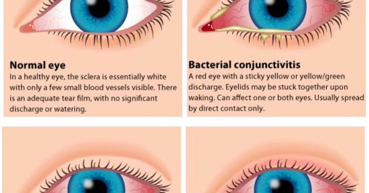 Know the Types, Treatments and Prevention of Infectious Eye Disease