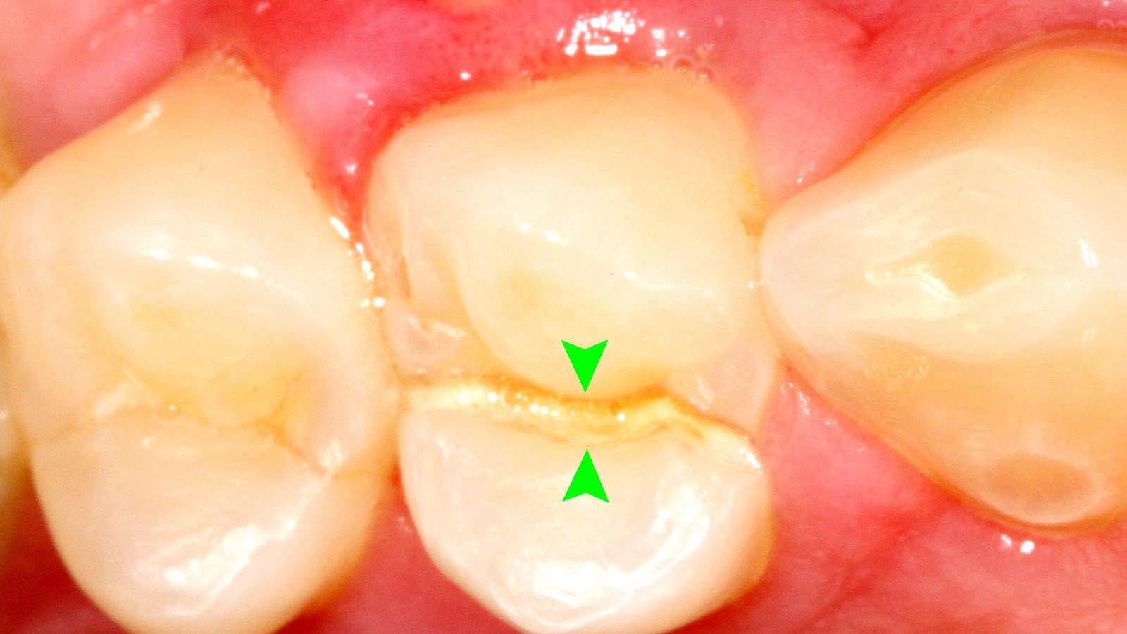 Mouth ulcer Gingival Ulcer Ulcer Choices