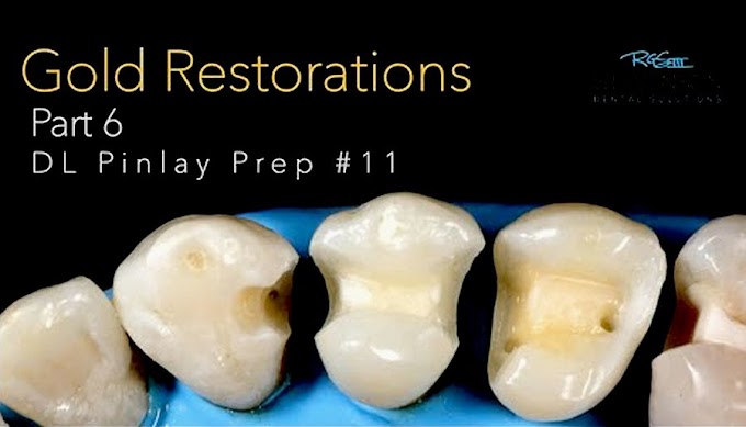 CAST GOLD Restorations - PART 6: PINLAY #11 PREP -  Dr. Richard Stevenson