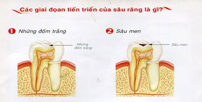 Làm thế nào để phát hiện sâu răng sớm?